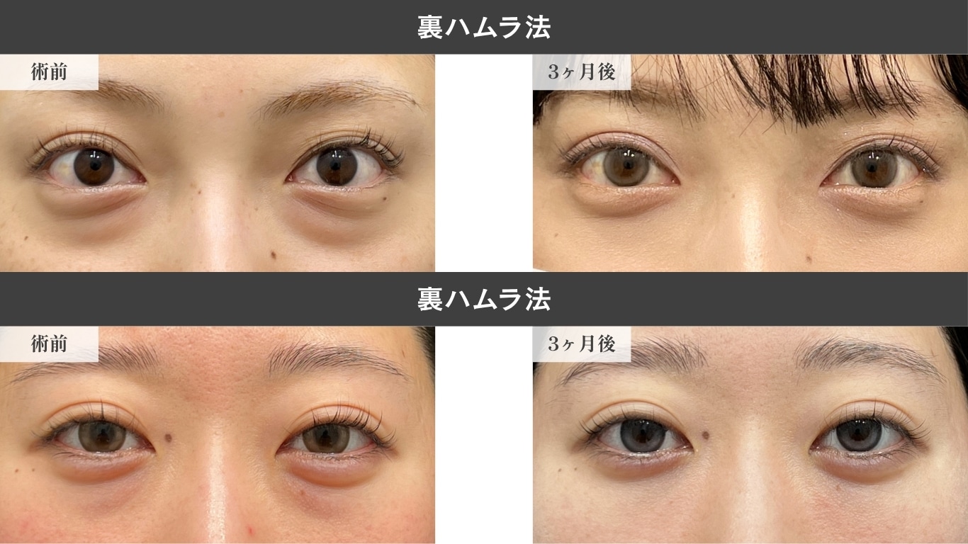 〈20代女性〉裏ハムラ法症例写真