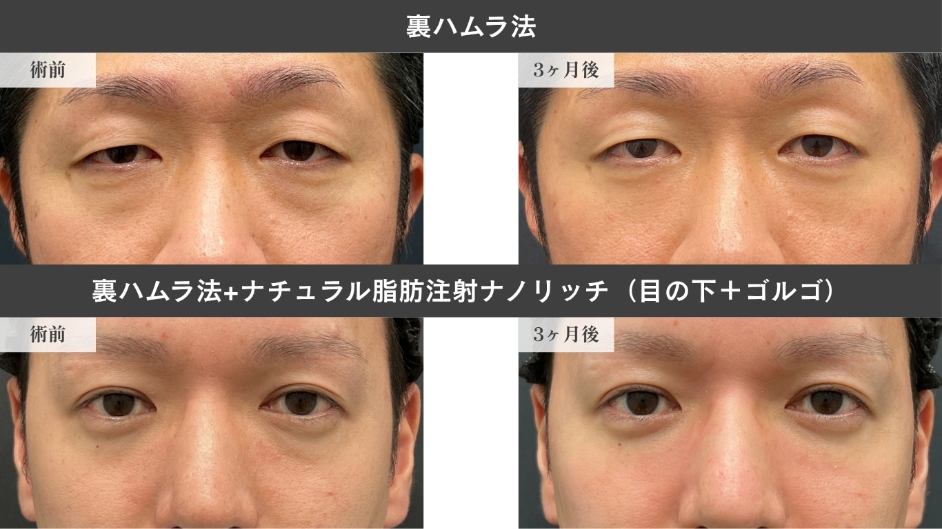 〈30代男性〉裏ハムラ法症例写真