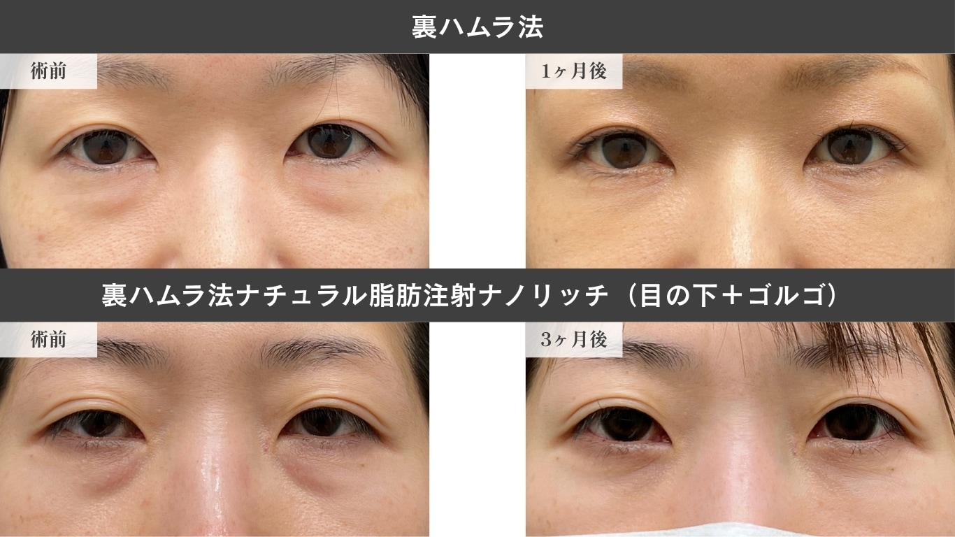 〈30代女性〉裏ハムラ法症例写真