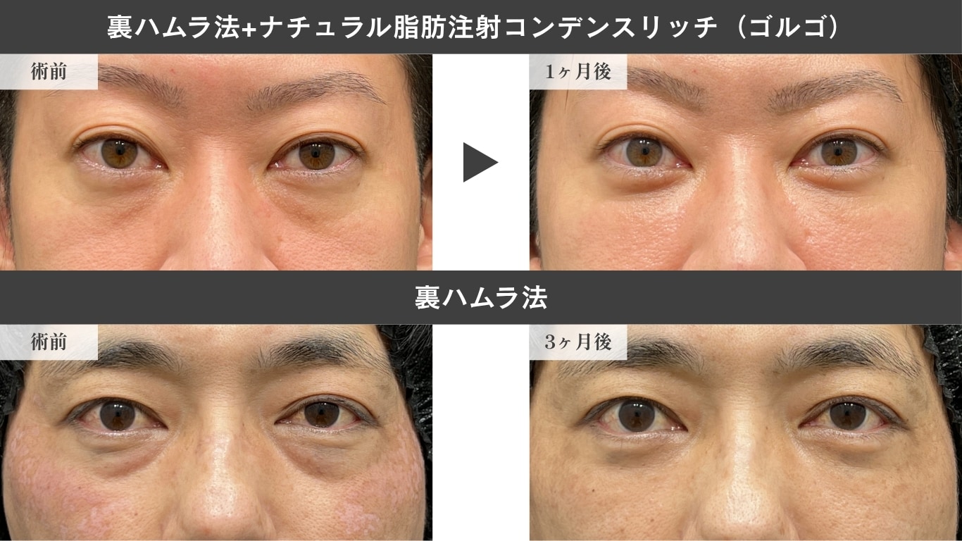 〈40代男性〉裏ハムラ法症例写真