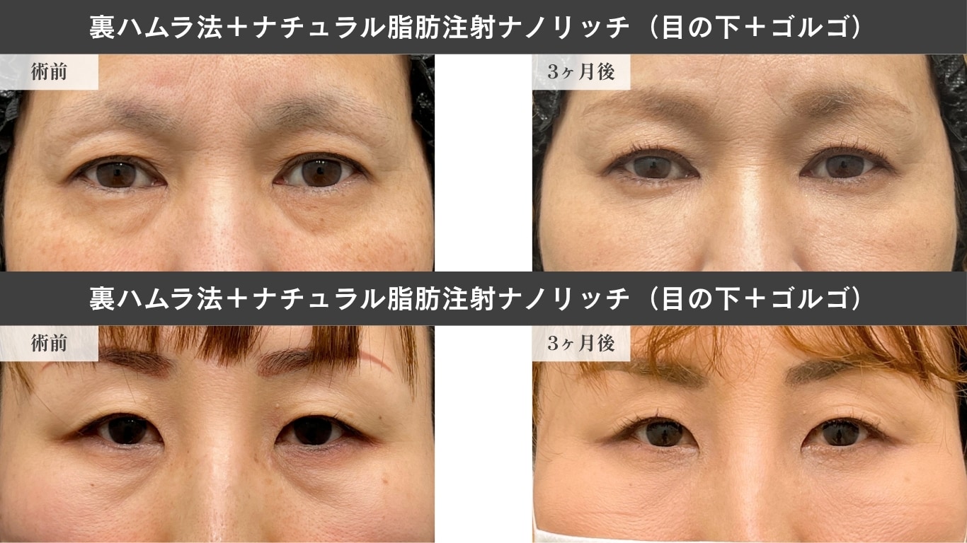 〈40代女性〉裏ハムラ法症例写真