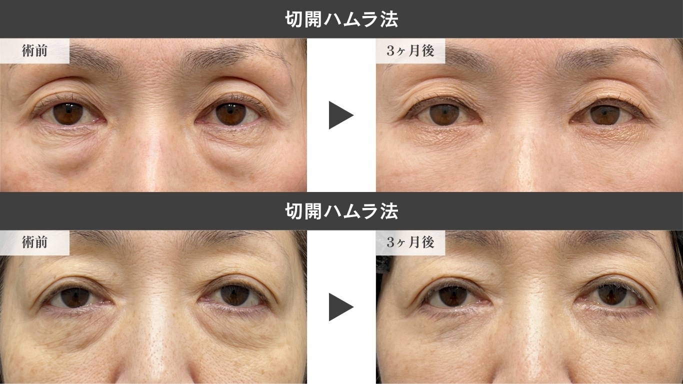 切開ハムラ法症例写真