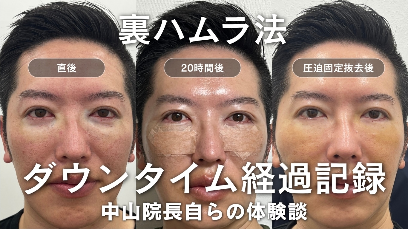 【実体験】裏ハムラのダウンタイムは何日？中山院長自らの経過写真と早く治すコツ