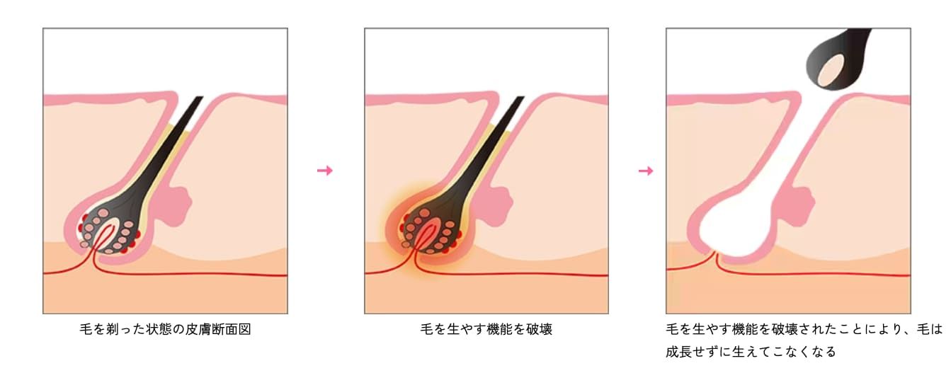 毛根の「色素」に反応して発毛組織を破壊