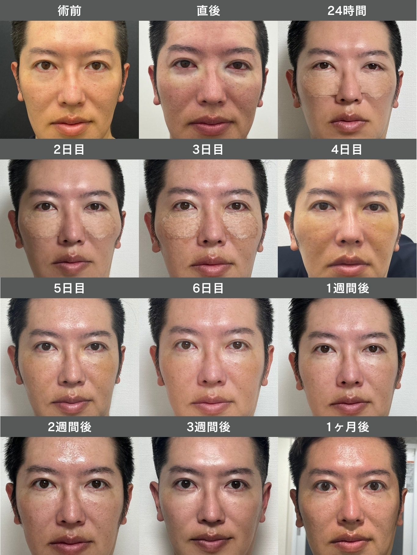 【執刀医自身が体験】<br />
中山院長の裏ハムラ術前〜1ヶ月経過写真（男性）