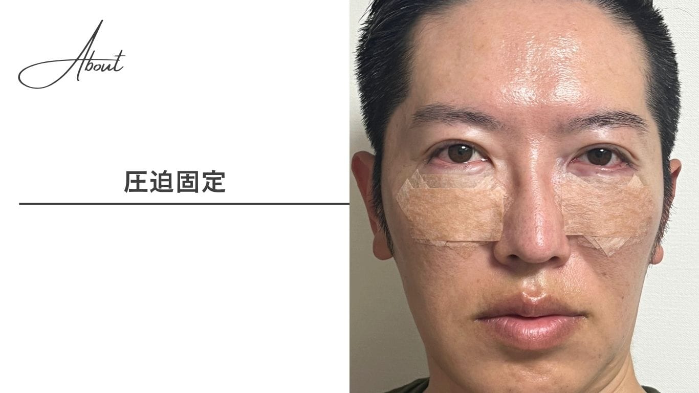【圧迫固定】術後48時間のテープ固定で腫れ・内出血を最小限に抑える