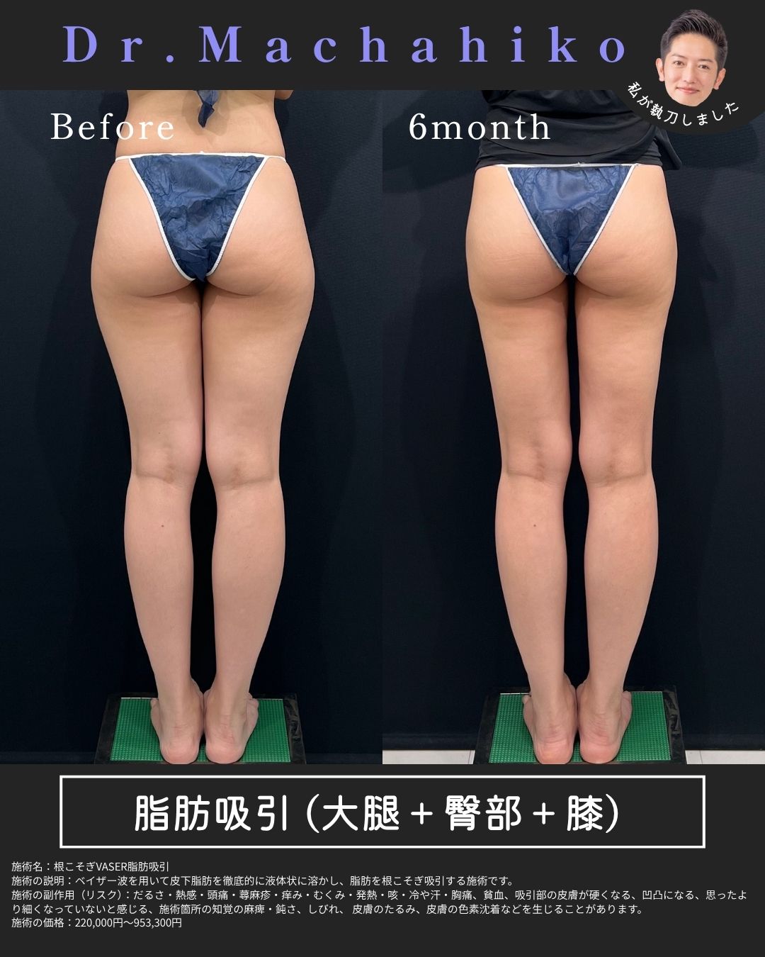 ベイザー脂肪吸引 大腿・臀部・膝