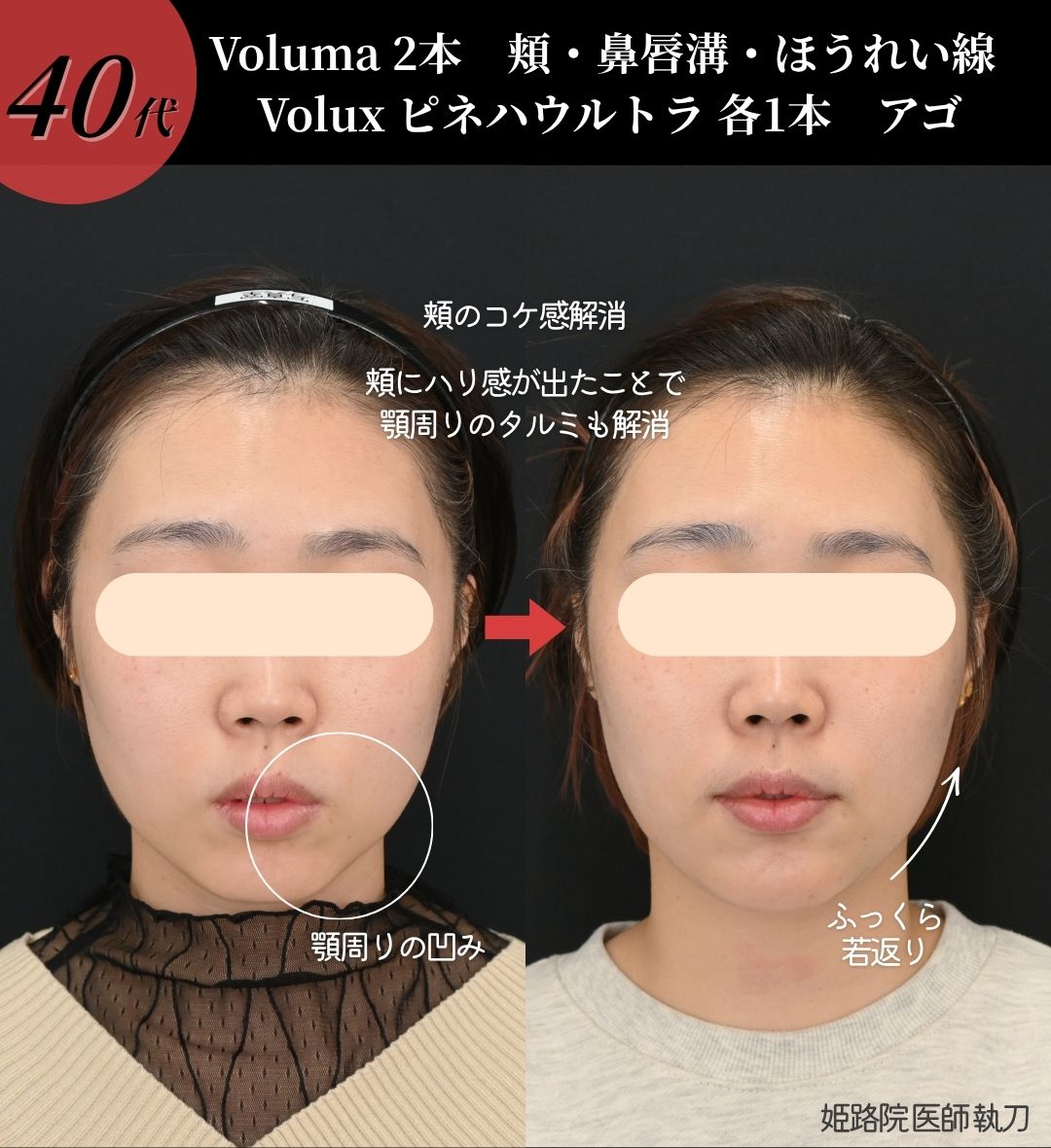 症例①：【頬コケ・ほうれい線・顎周り】全体のバランスを整えた若返り治療