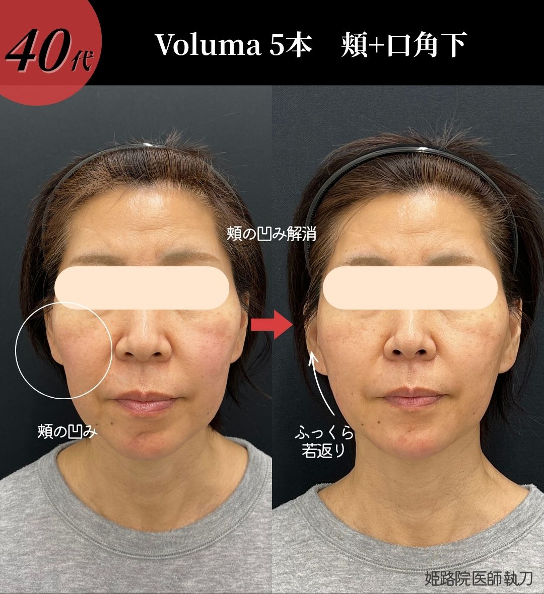 症例②：【頬の凹み・口角下】コケ感をふっくら整えて影を飛ばす若返り治療