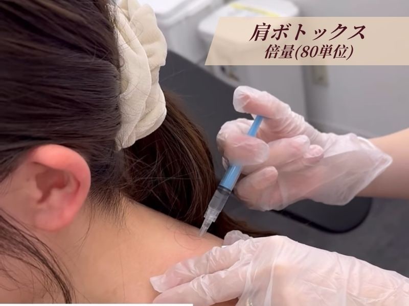 首長効果を狙った「肩ボトックス1回目」の施術