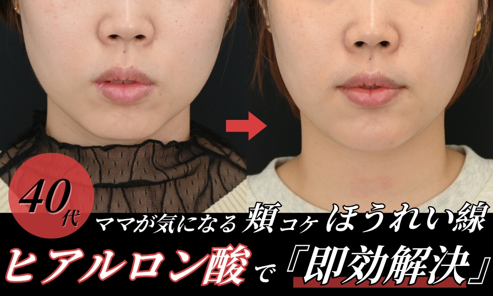 【姫路】40代の「ほうれい線・頬コケ」にヒアルロン酸治療がおすすめ!1回で即効・ダウンタイムなしの若返り