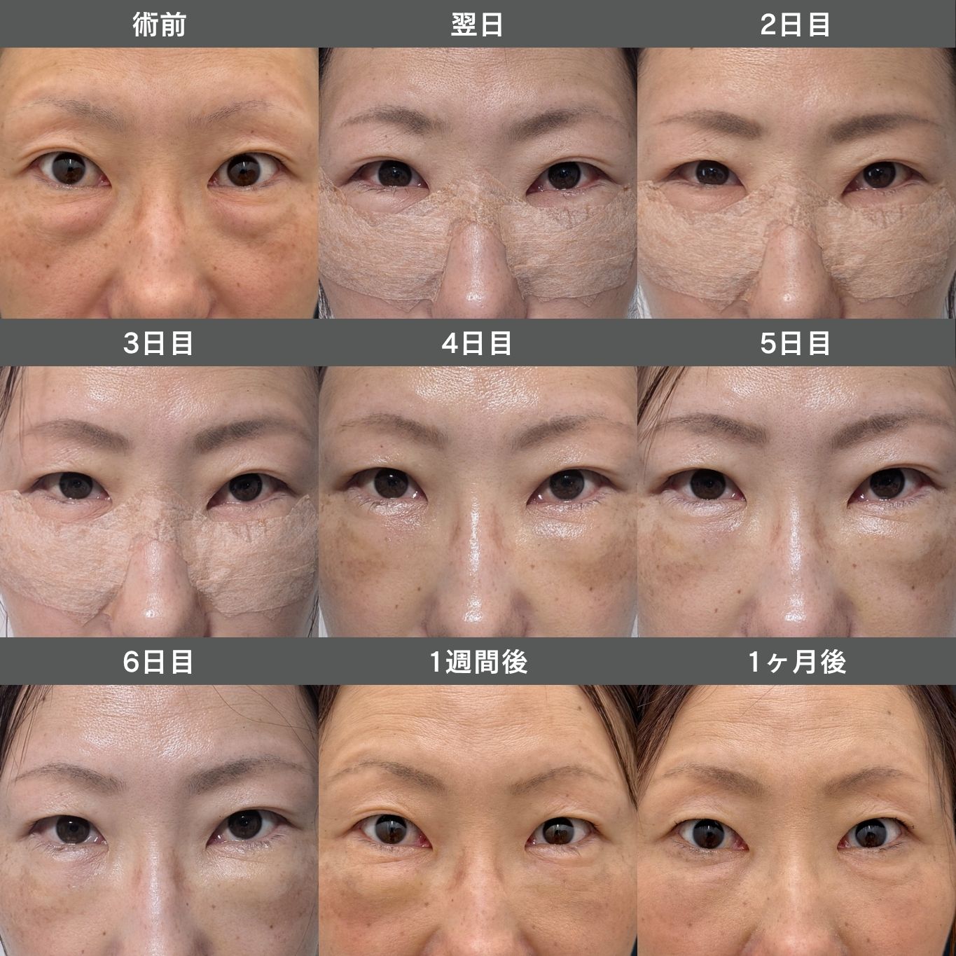 【症例比較】裏ハムラ法単体（女性）の術前〜1週間の毎日経過写真