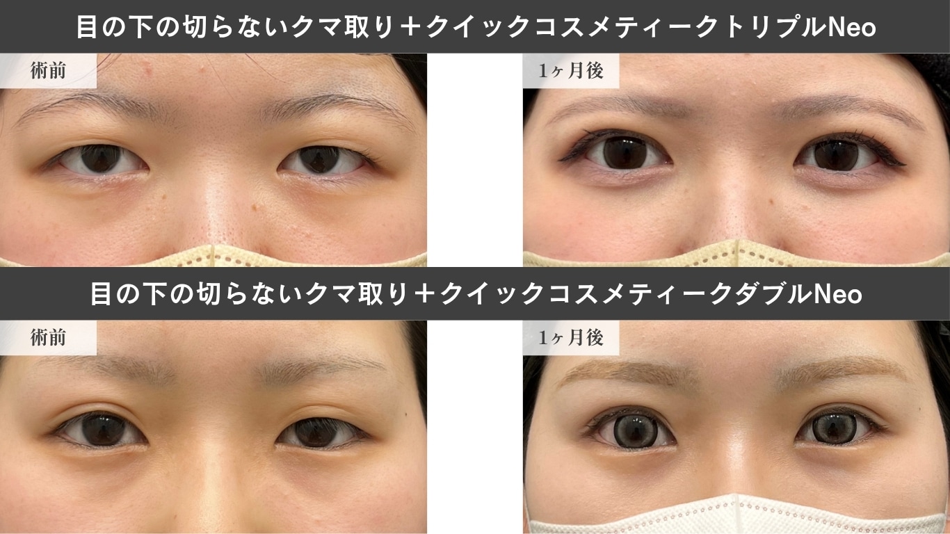 目の下の切らないクマ取り症例写真