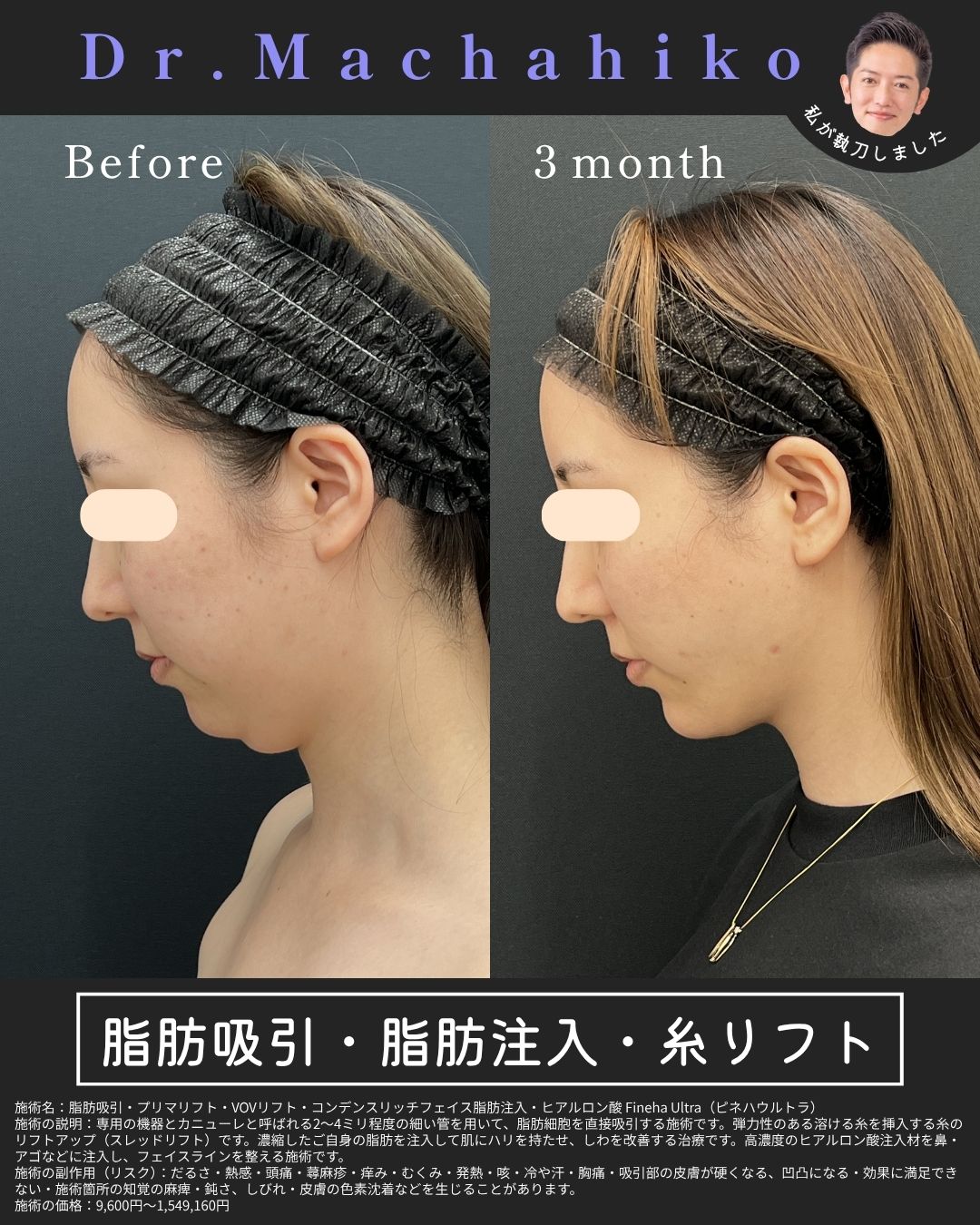 顔の脂肪吸引