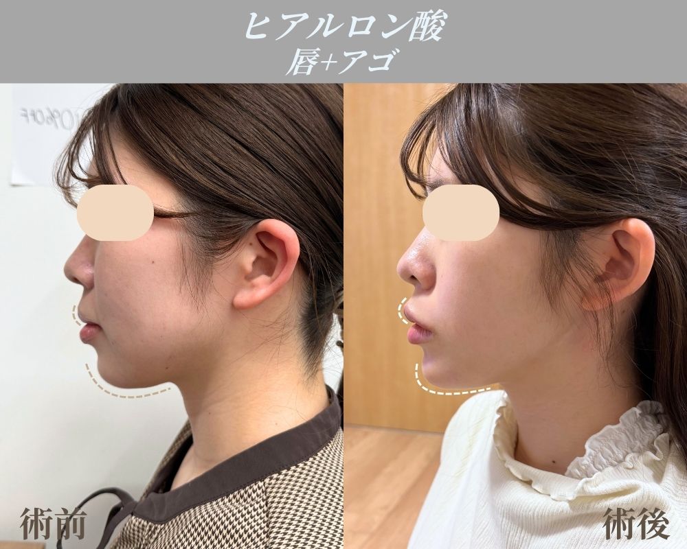 ボトックス→ヒアルロン酸の順番でEラインを劇的完成！