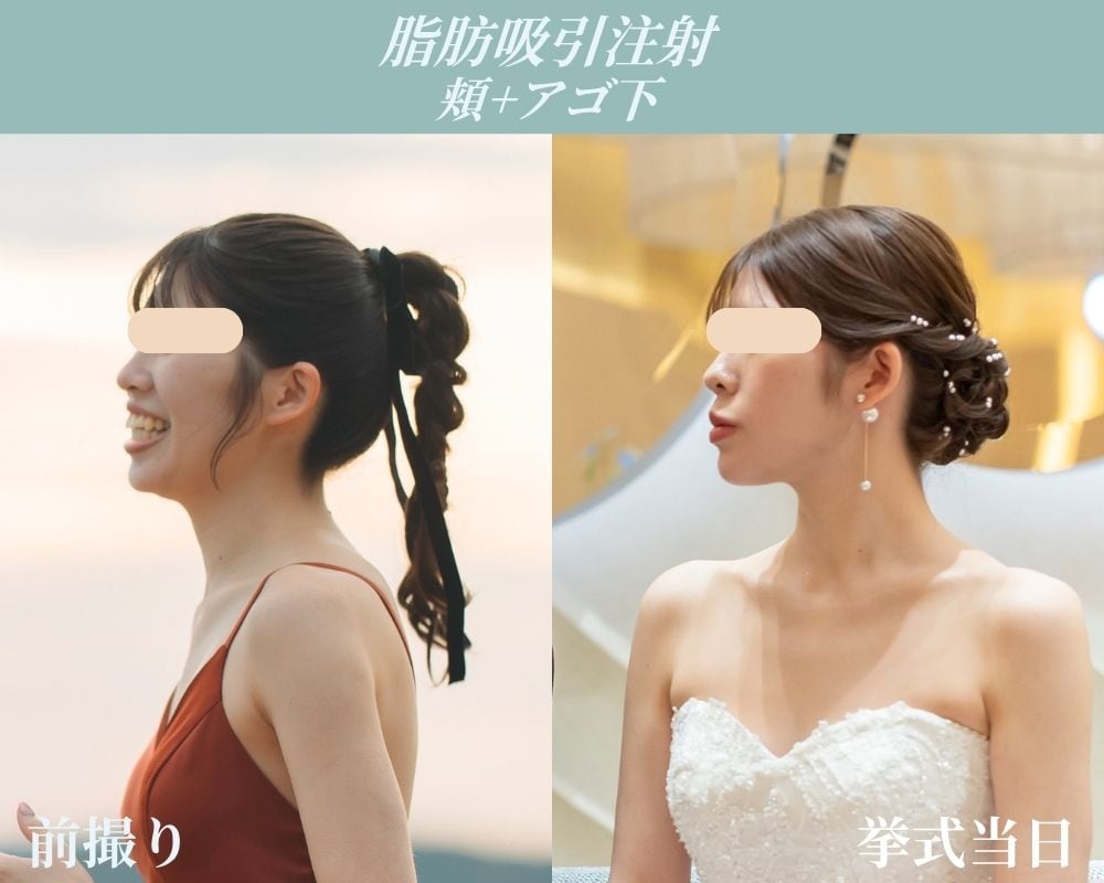 後悔のないフィスラインの完成
