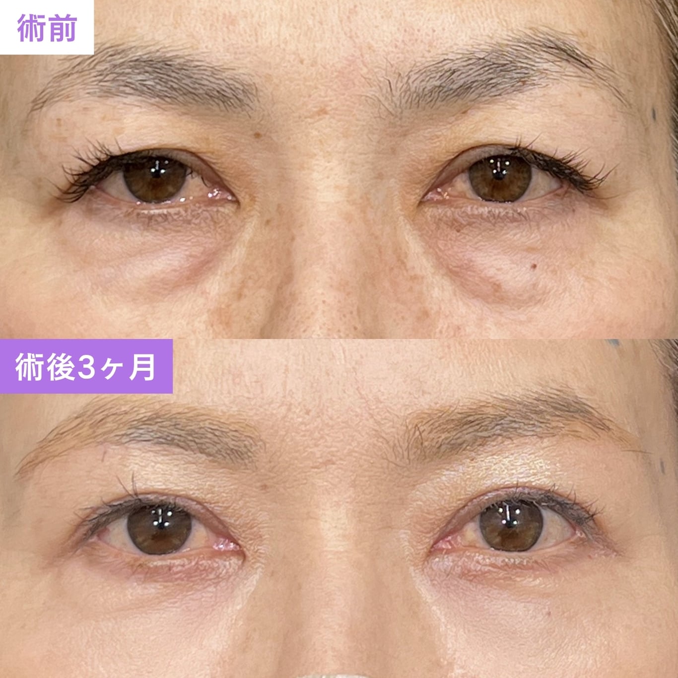 【症例①：50代女性】まぶたのたるみを改善し、華やかで自然な目元へ