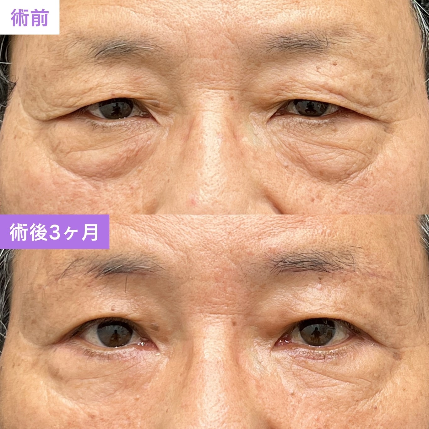 【症例②：60代男性】重たい印象を解消し、凛とした自然な目元へ