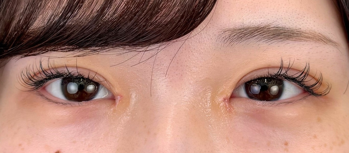 術後8日目：抜糸翌日