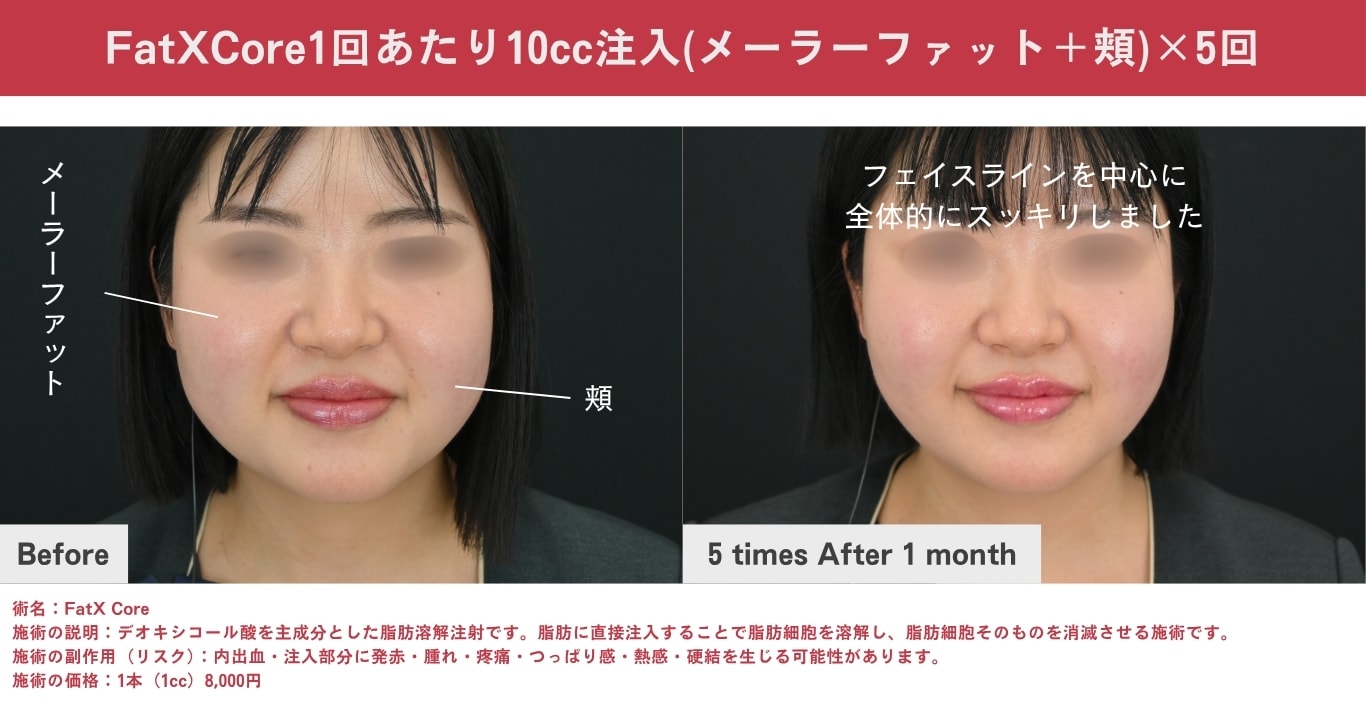 脂肪溶解注射［FatX Core・山参注射］（切らずに部分痩せ・ダウンタイムを抑えたい方）