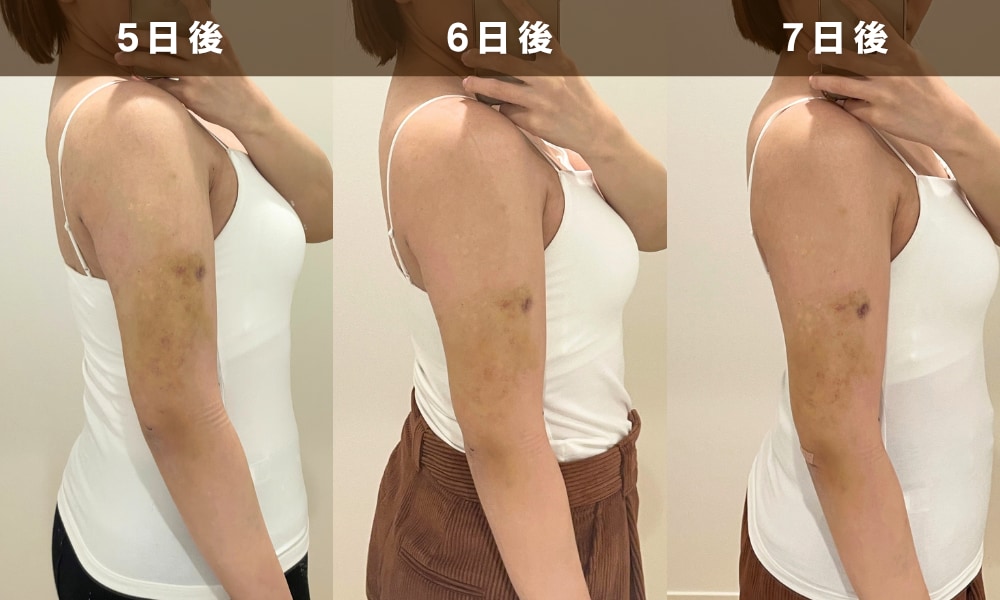 術後1週間（抜糸期）：内出血の黄変化とかゆみ