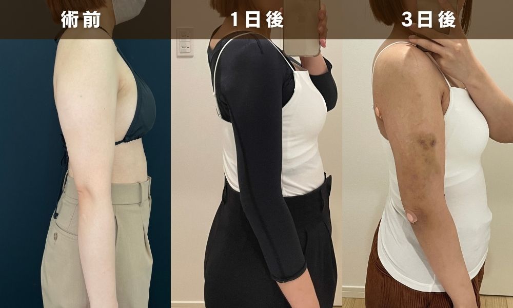 術後1〜3日目：痛みのピークとむくみの状態