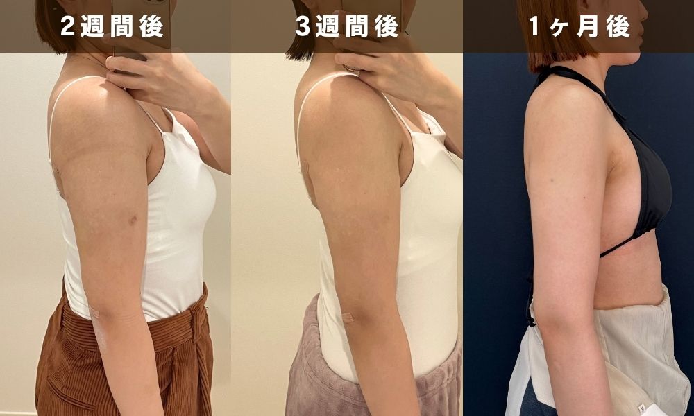 術後2週間〜1ヶ月：拘縮（こうしゅく）とボコボコ感の理由