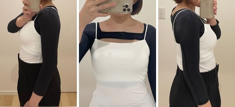 二の腕アキーセル脂肪吸引 術後1日目の専用圧迫着（ボレロ）着用画像。前ホック仕様の胸元と二の腕の固定状態を示す正面・両側面の比較写真。