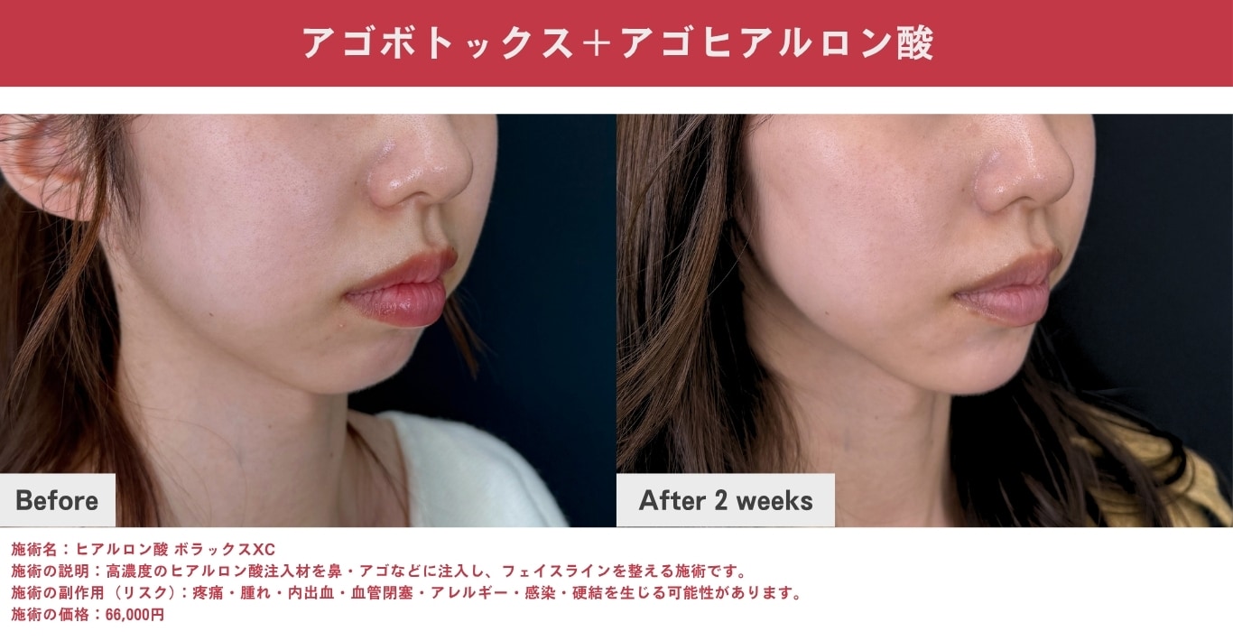 アゴボトックス×アゴヒアルロン酸（Eラインを整えてシャープに見せたい方）