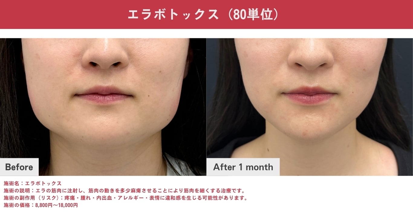エラボトックス（筋肉の張り・エラ張りが気になる方）