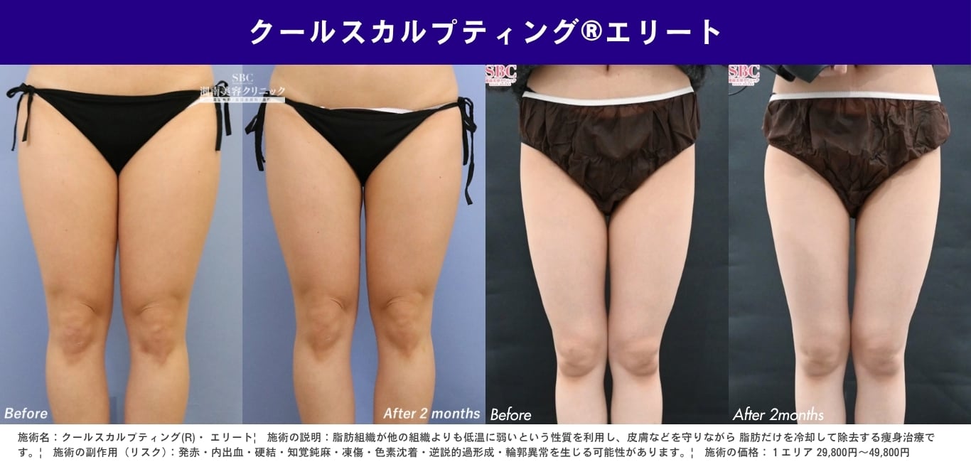 切らずに寝ているだけでサイズダウン「クールスカルプティング®」