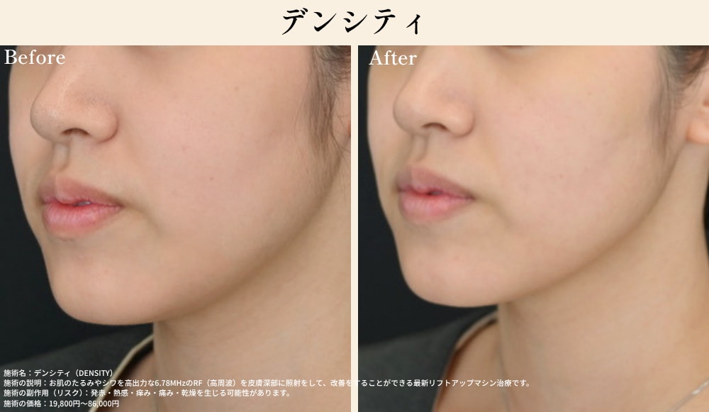 SBC姫路院 デンシティ（高周波RF）の症例写真・たるみ毛穴引き締め効果