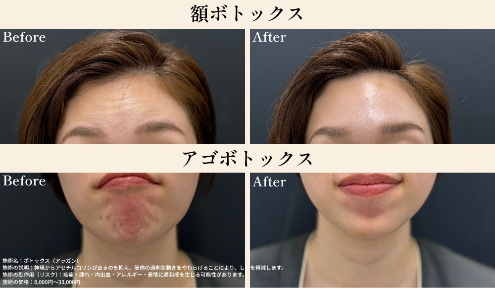 SBC姫路院の額ボトックスおよびアゴボトックスの症例写真。施術前（Before）と施術後（After）の表情ジワ・オトガイ筋の比較画像