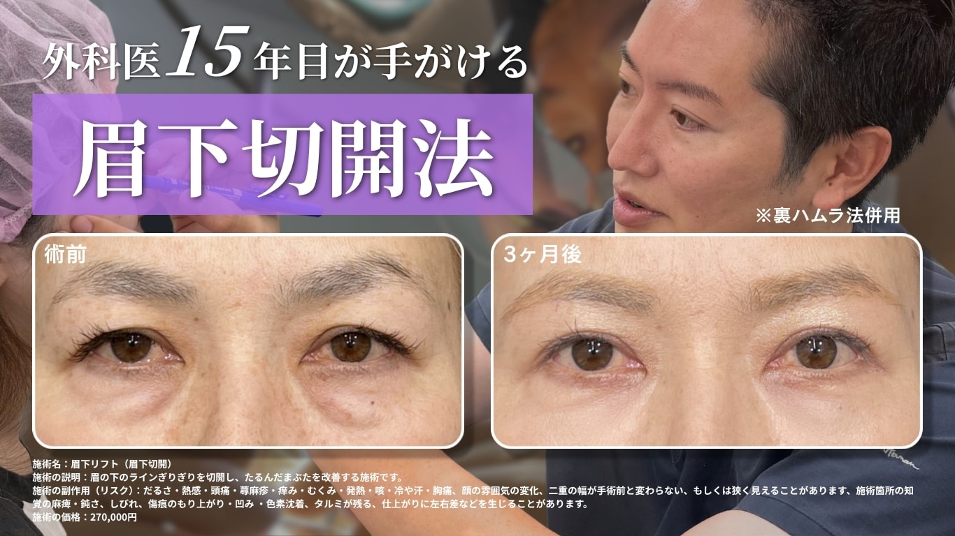 【姫路・加古川】眉下切開なら湘南美容クリニック｜外科医15年目の中山院長・症例有