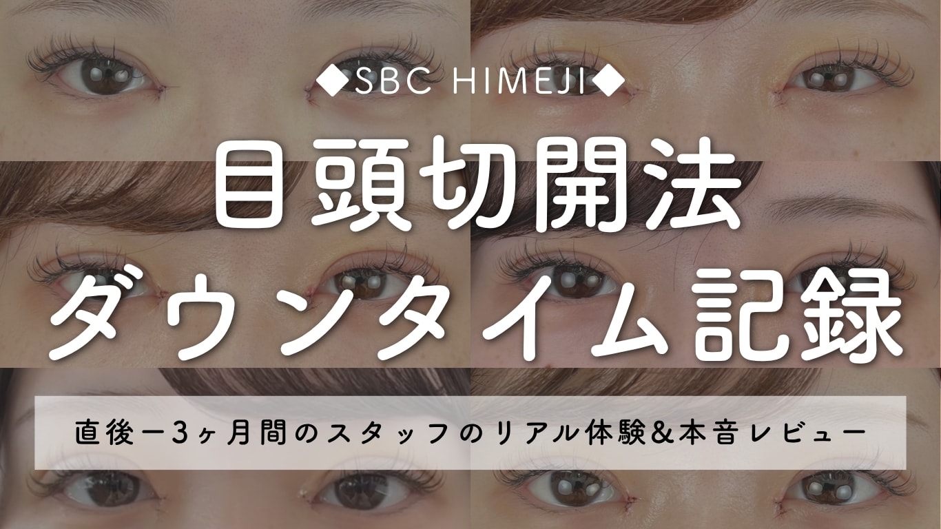 目頭切開と二重術を受けた当院スタッフのダウンタイム経過写真｜湘南美容クリニック姫路院
