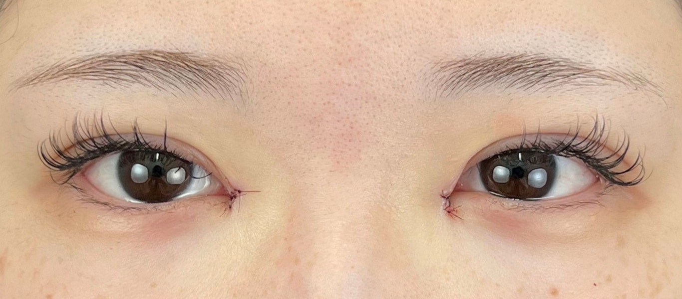 術直後：腫れはまだ目立たない状態