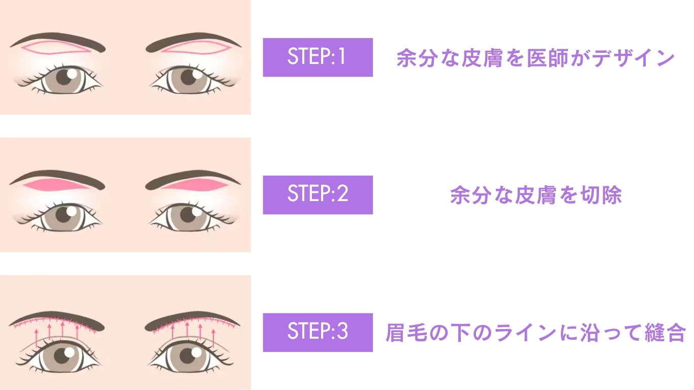 眉下切開の仕組み