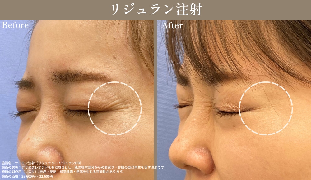 SBC姫路院のリジュラン注射(サーモン注射)目元症例写真。施術前(Before)と施術後(After)の目尻・下まぶたの小ジワ改善とハリ・皮膚再生効果の比較画像