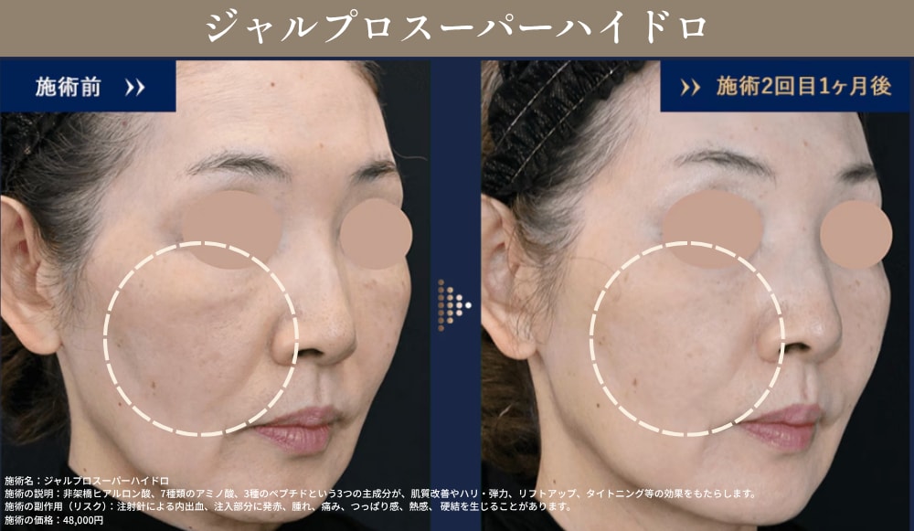 SBC姫路院 ジャルプロ(ECM製剤)の症例写真・コラーゲン生成とリフトアップ効果