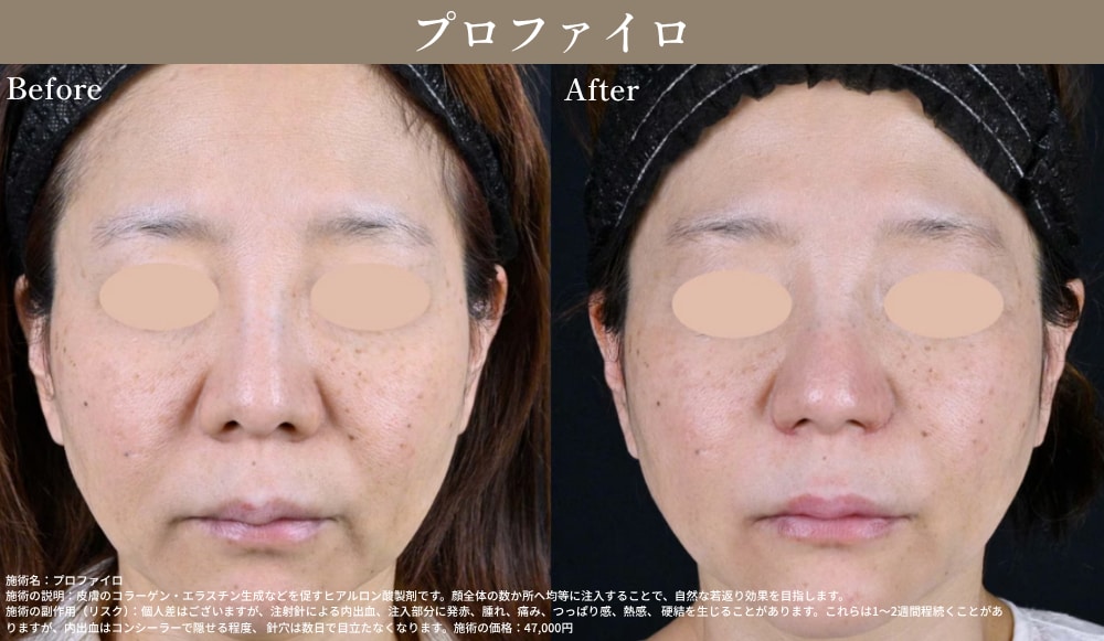 SBC姫路院 プロファイロ(バイオリモデリング製剤)の症例写真・お顔全体の自然なハリ・ツヤ・肌質改善効果