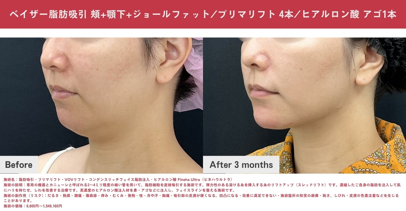 脂肪吸引 / 脂肪吸引注射（頬・あご下の脂肪をしっかり落としたい方）