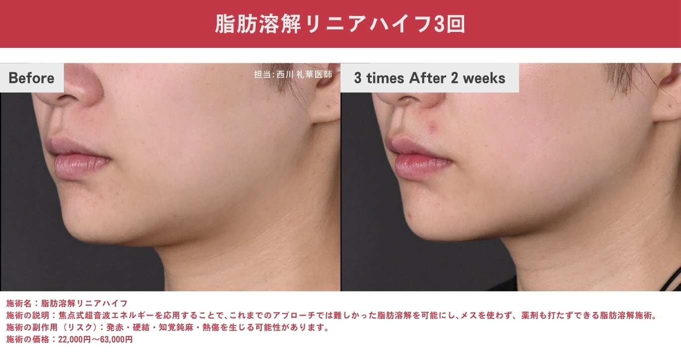 新・脂肪溶解リニアHIFU（二重あご・フェイスラインのたるみが気になる方）