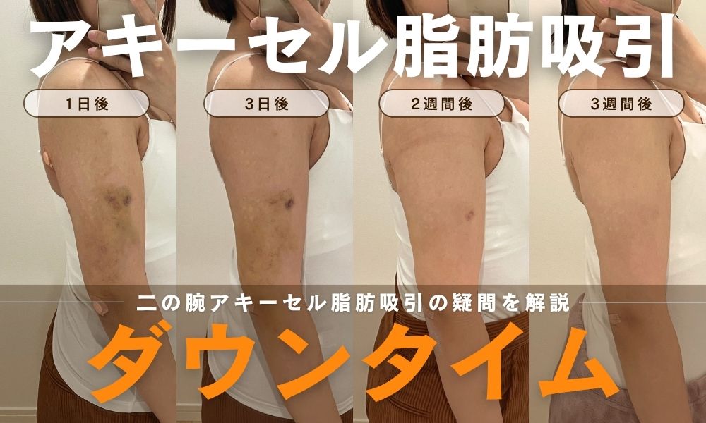 二の腕アキーセル脂肪吸引のダウンタイム経過を示す4分割の比較画像。トップに「アキーセル脂肪吸引」、ボトムに大きく橙色で「ダウンタイム」の文字。中央に「二の腕アキーセル脂肪吸引の疑問を解説」の文字。左から右へ、施術後の内出血や腫れが徐々に引き、すっきりとした腕になっていく様子がわかる