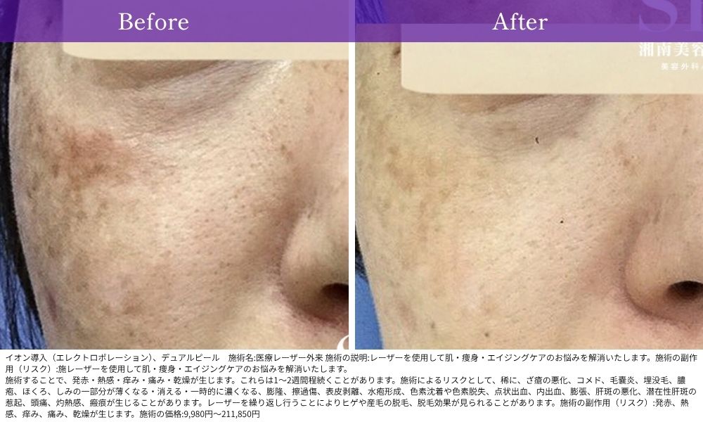 【毛穴の開き・ハリ・ツヤ改善】デュアルピールの症例