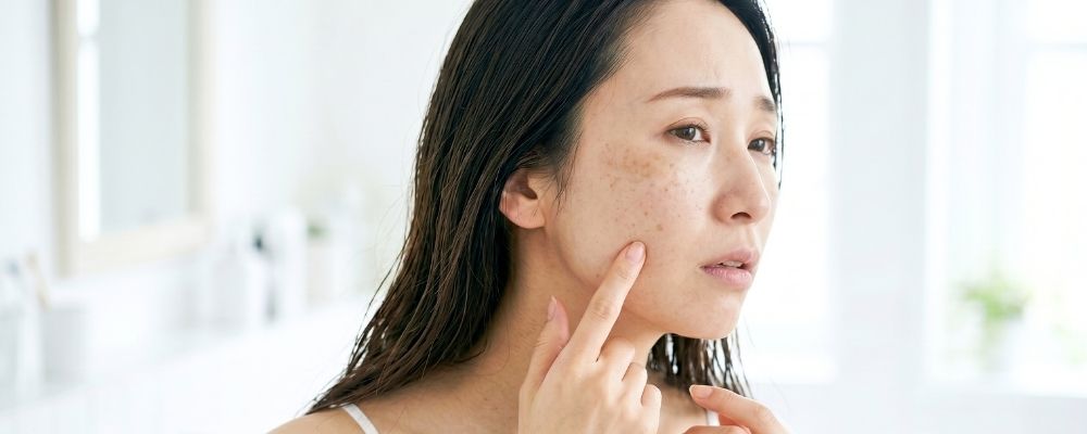 肝斑やシミ・くすみに悩む女性