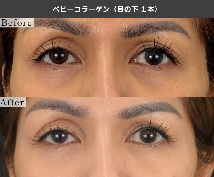 ベビーコラーゲン 目の下1本の症例写真