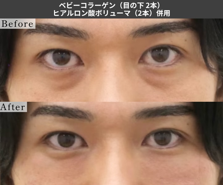 ベビーコラーゲン ヒアルロン酸併用の症例写真