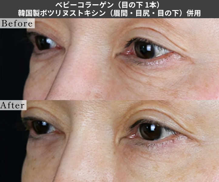 ベビーコラーゲン ボトックス併用の症例写真