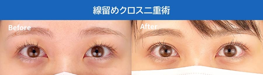 線留めクロス二重術