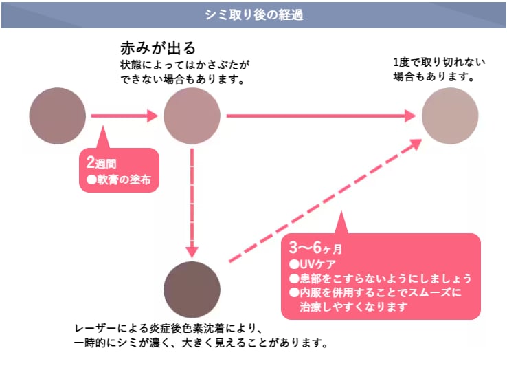 シミ取りレーザー後の経過